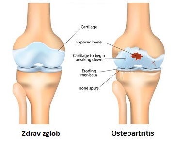 Osteoartritis ili artroza - Poliklinika Fizikus