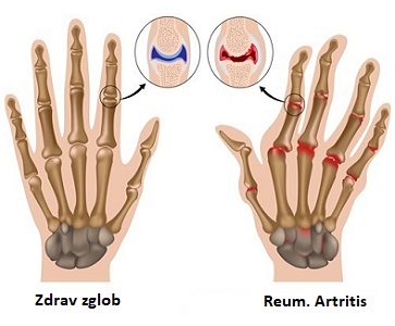 Reumatoidni Artritis - Poliklinika Fizikus